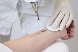 لیزر درمانی تاتو